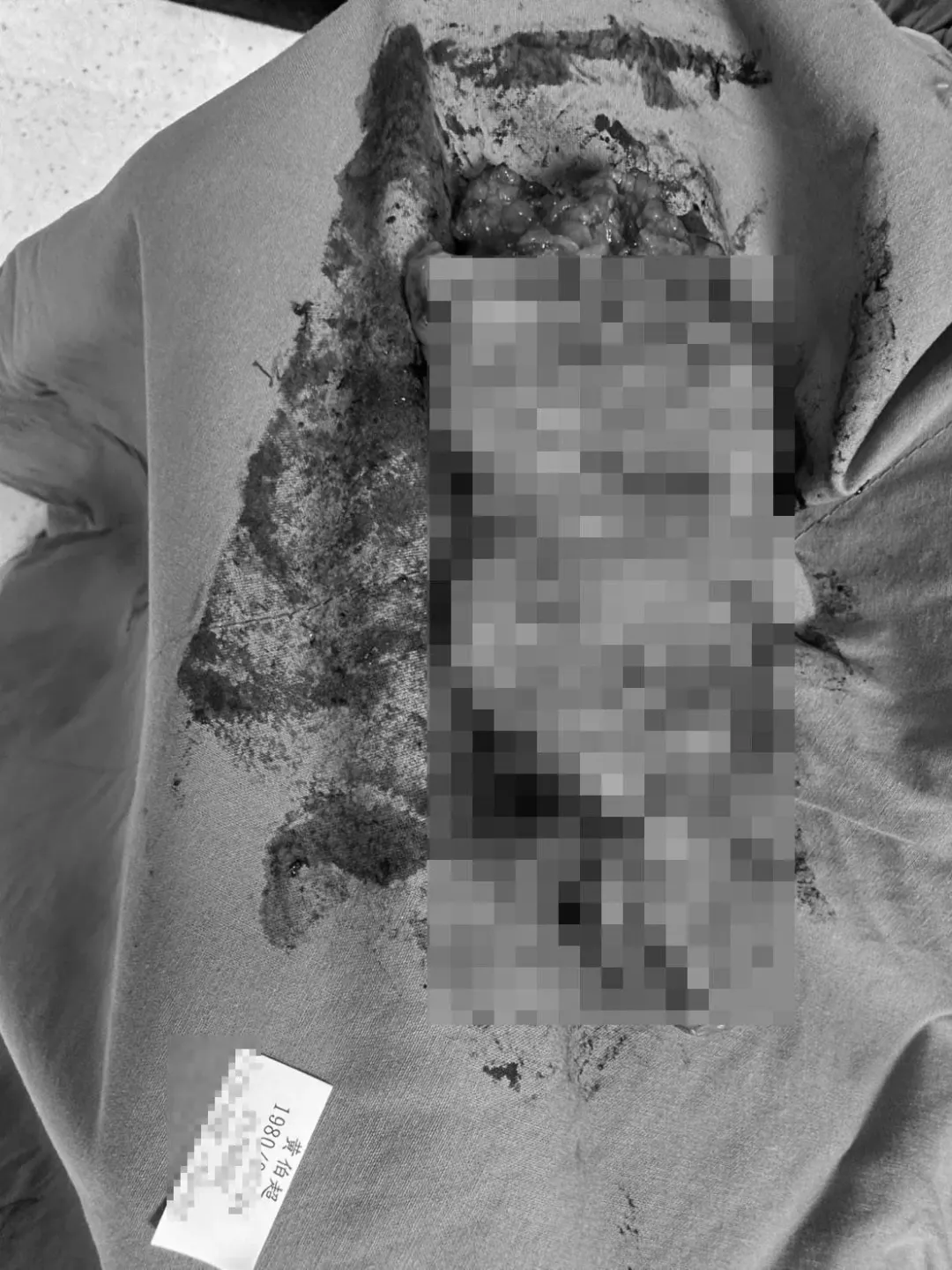 超哥罹患大腸癌0期，在跨年當天開刀治療。（圖／超哥提供）