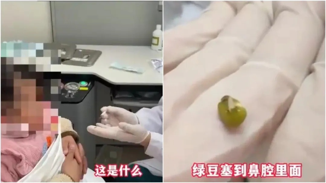 湖北一名週歲女童流鼻涕不止,醫生從她鼻孔挖出一顆發芽綠豆。(圖/翻攝微博)