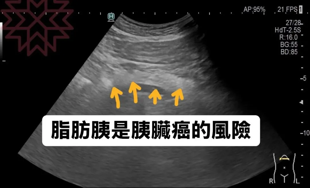 根據最新研究發現，高達62%的胰臟癌患者都有「脂肪胰」。（圖／翻攝自胰臟醫師 林相宏 禾馨民權內科診所）