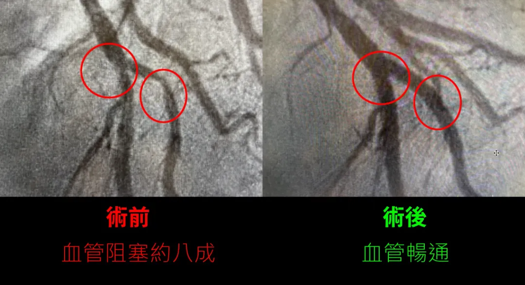 一名70多歲長者，除了心房顫動心律不整，還有冠狀動脈疾病，接受心導管檢查及治療後症狀和體力明顯改善。（圖／中國醫藥大學新竹附設醫院）