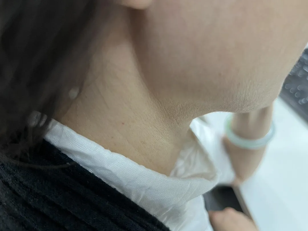 醫師提醒，若出現疲倦、喘氣及水腫等症狀，且頸部靜脈持續浮起不消退，可能是心臟衰竭的重要警訊。（圖／中天新聞）