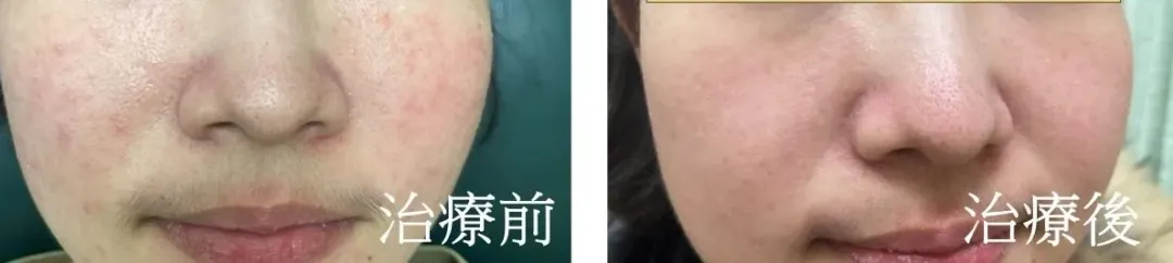 經治療後,患者皮膚狀況大幅改善。(圖/亞洲大學附屬醫院)
