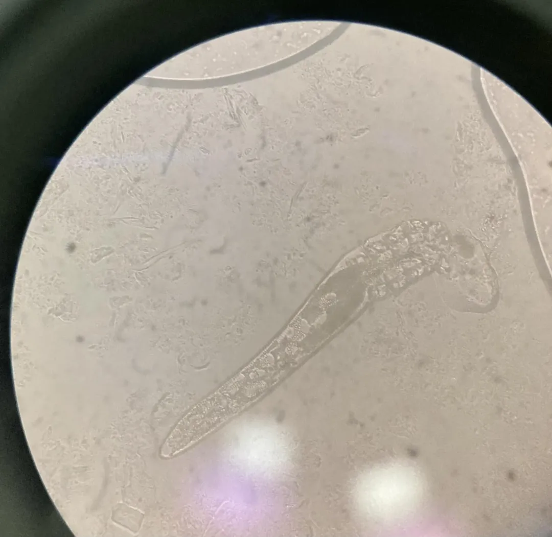 部分頑固型玫瑰斑甚至與蠕形蟎蟲增生有關。(圖/亞洲大學附屬醫院)