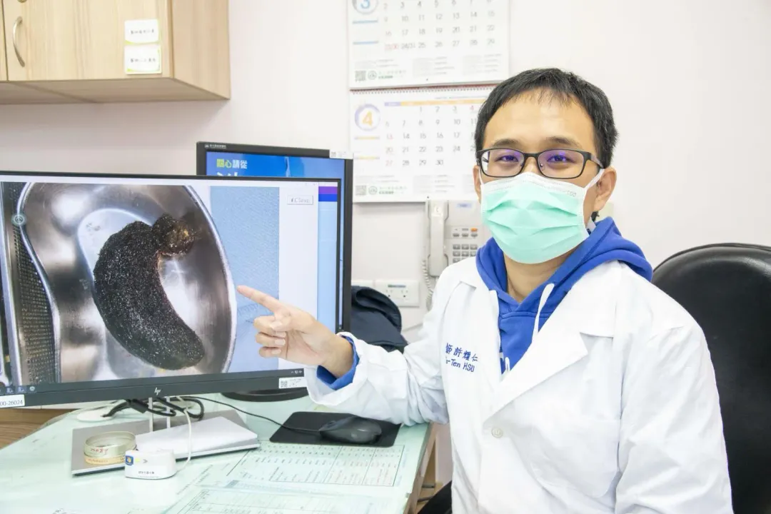 兒童外科許耀仁醫師指出團隊透過胃造口手術取出胃內巨大毛石及小腸三顆較小毛石。（圖／彰化基督教兒童醫院）