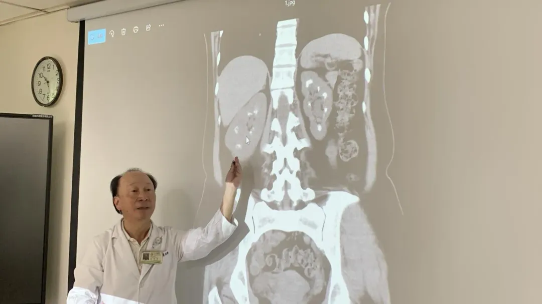 臺中醫院泌尿科主任朱朗軒說明，患者因副甲狀腺亢進導致鈣質代謝失衡，兩顆腎臟沉積大量小石頭宛如「滿天星」。（圖／臺中醫院提供）