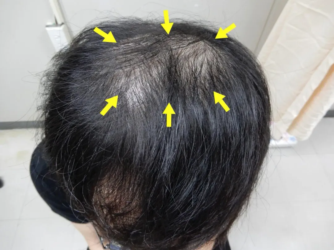 一名30多歲的年輕男性，工作極為忙碌，原有一頭茂密秀髮，幾個月前發現髮量越來越少，常可扯落一綹髮絲。（圖／澄清醫院）