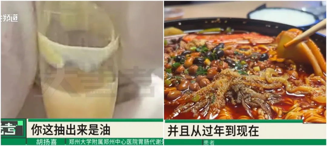 王女每天必吃火鍋或燒烤，連續4個月下來被抽出「奶油血」，血液裡都是油。（圖／翻攝微博）