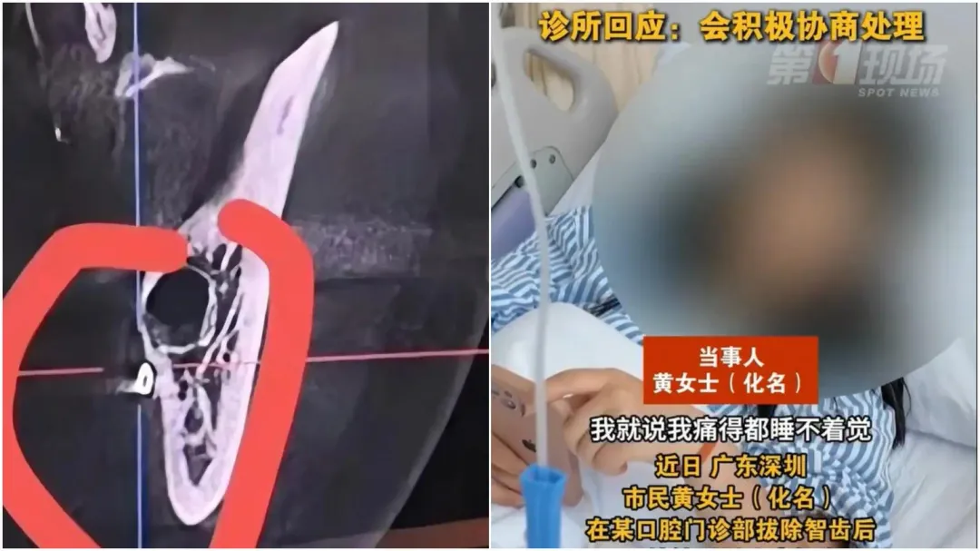 深圳黃女拔智齒遭遺留手術針在口腔內。(圖/翻攝微博)