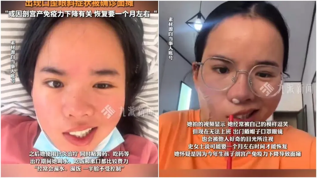 大陸史姓女子午休吹完電風扇後突然面癱。（圖／翻攝微博）
