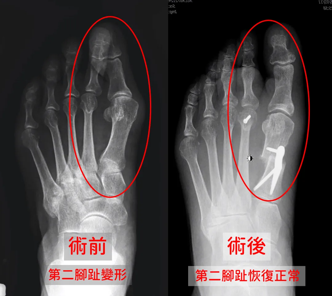 楊子正醫師指出，拇指外翻合併第二腳趾變形的矯正，需同時處理兩個問題，避免相互影響。（圖／中國醫藥大學新竹附設醫院）