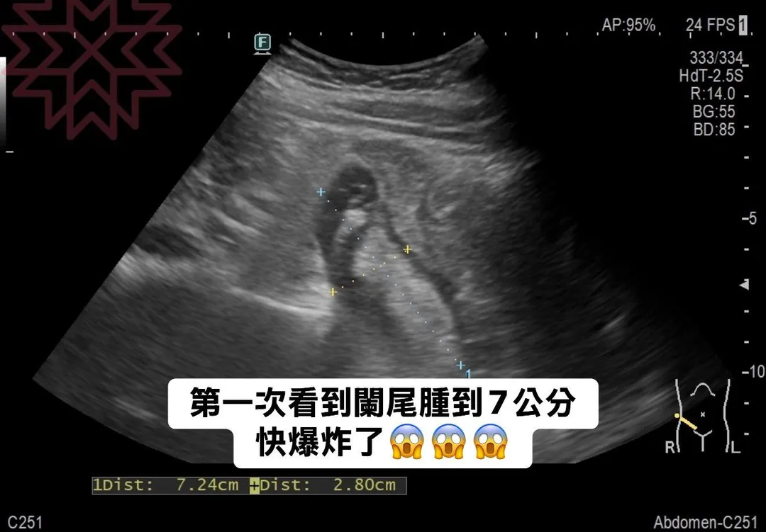 一名40歲女性因胃部劇痛就醫，經診斷發現是罕見的巨大闌尾炎，腫脹程度達7公分。（圖／翻攝自胰臟醫師 林相宏 禾馨民權內科診所）