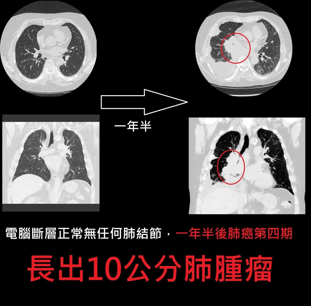 這名病患被診斷出罹患的是肺小細胞癌,這類型肺癌具有極高的惡性度,生長速度驚人。(圖/翻攝自蘇一峰)