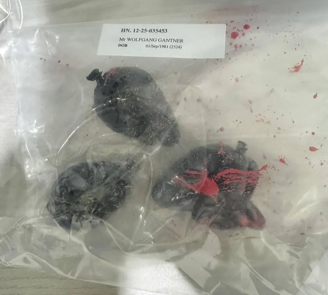 醫護人員從男子體內取出3個黑色毒品包裹。(圖/翻攝自Facebook@สถานีตำรวจนครบาลหัวหมาก)
