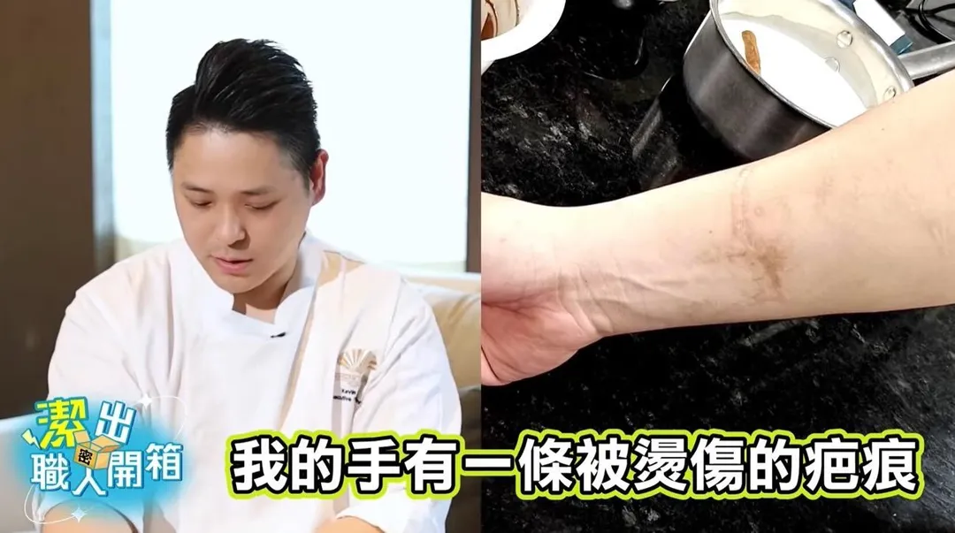 趙崇曦在學習糖藝雕塑時，因高溫糖液操作不慎，180度的熔糖瞬間湧上手臂，造成嚴重燙傷與永久疤痕。（圖／潔出職人開箱潔出職人開箱潔出職人開箱潔出職人開箱潔出職人開箱潔出職人開箱潔出職人開箱）