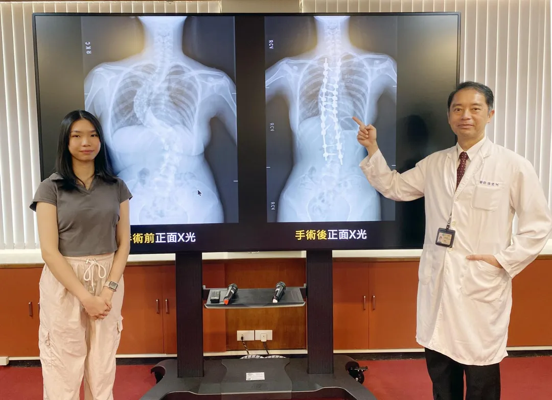 黃同學(左)脊椎側彎達90度,臺中榮總骨科部脊椎外科主任潘建州(右)為她進行脊椎機械手臂手術,成功矯正。(圖/臺中榮總)
