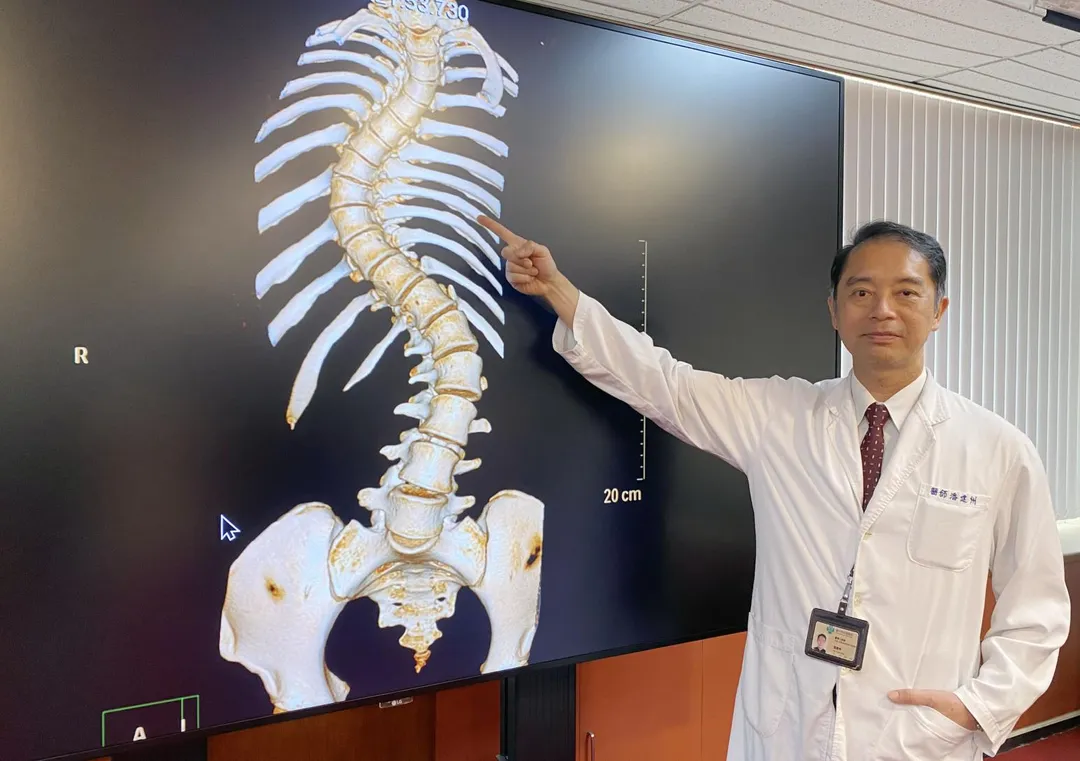 臺中榮總骨科部脊椎外科主任潘建州指出,黃同學術前電腦斷層可見其脊椎嚴重側彎。(圖/臺中榮總)