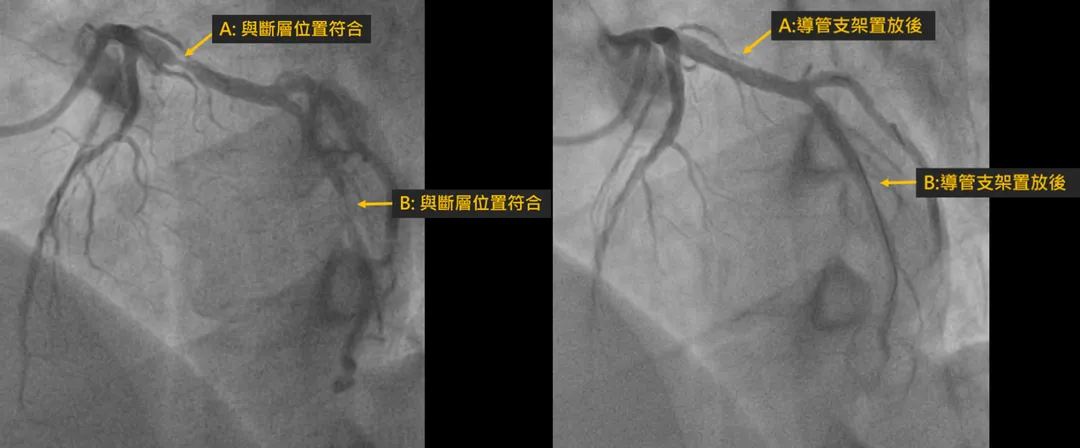 心導管檢查顯示,林先生冠狀動脈阻塞處與斷層位置高度重合,經冠狀動脈支架置放後,林先生的血管已無狹窄問題。(圖/安南醫院)