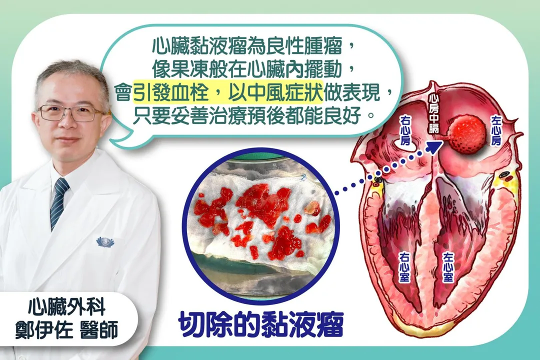 鄭伊佐醫師說明,心臟黏液瘤為良性腫瘤,像果凍般在心臟內擺動,會引發血栓,以中風症狀做表現,只要妥善治療預後都能良好。(圖/台中慈濟醫院)