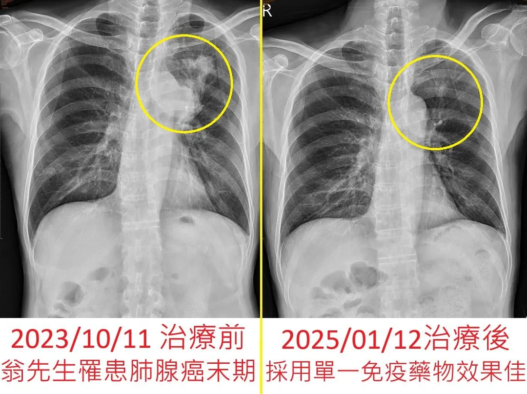 罹癌的翁姓婦人哥哥治療成果佳。（圖／烏日林新醫院）