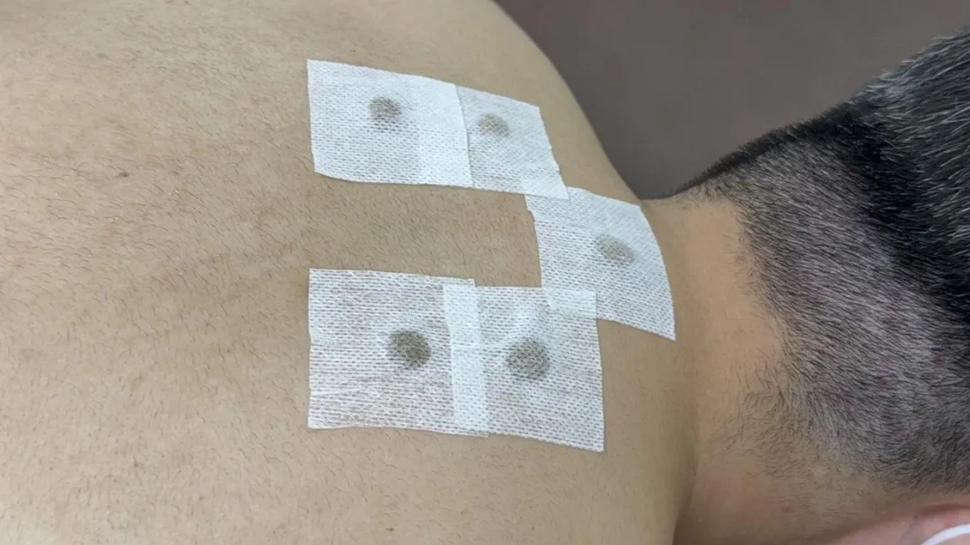 三伏貼是在一年中最炎熱的節氣，於背部包括大椎、風門、肺俞、定喘等特定穴位敷貼藥物，刺激穴位達到改善過敏、調節體質的目的。（圖／衛生福利部臺中醫院）
