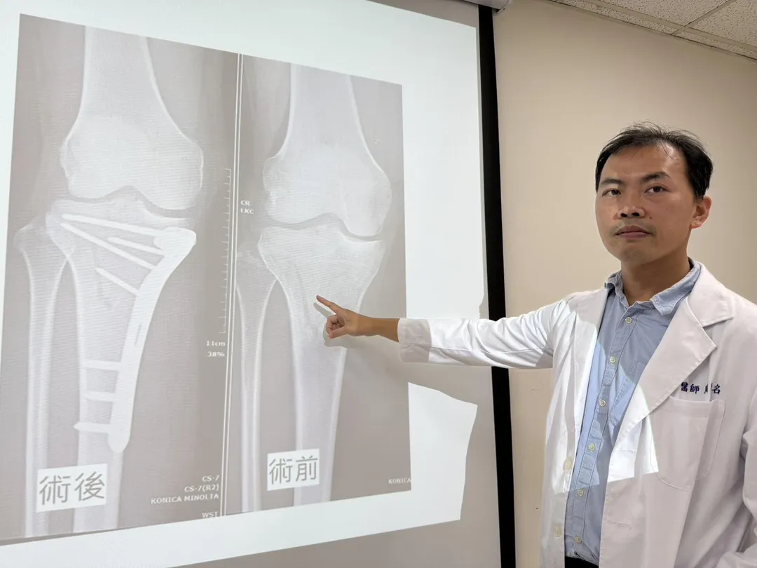 42歲「血拼姐」與姊妹淘相約到百貨公司購物途中遭遇車禍，就醫檢查發現右腿脛骨呈現「V字型」骨折（周育名醫師手指處）。（圖／臺中醫院）
