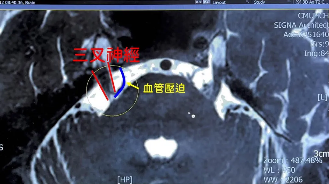 60歲男子長期飽受右側臉部如電擊般劇痛所苦，連吃飯、說話都會引發疼痛，經診斷為三叉神經痛。（圖／中國醫藥大學新竹附設醫院）