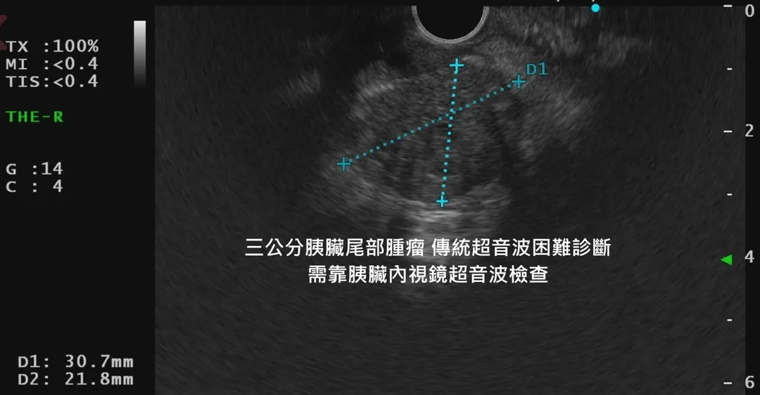 發現3公分胰臟癌腫瘤。（圖／翻攝林相宏臉書）
