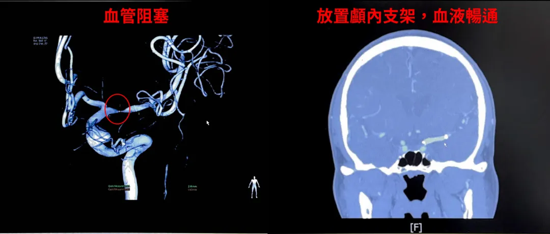 患者術前及術後。（圖／中國醫藥大學新竹附設醫院）&nbsp;