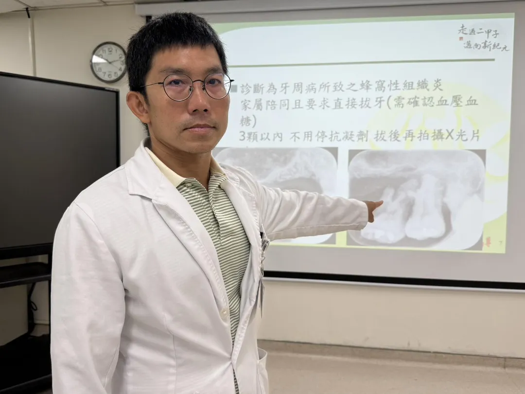 衛生福利部臺中 醫院牙科林佳詠主任說明52歲患者到院時，因左上大臼齒蛀牙未治療，細菌感染導致蜂窩性組織炎，臉腫發燒就醫。（圖／臺中醫院）
