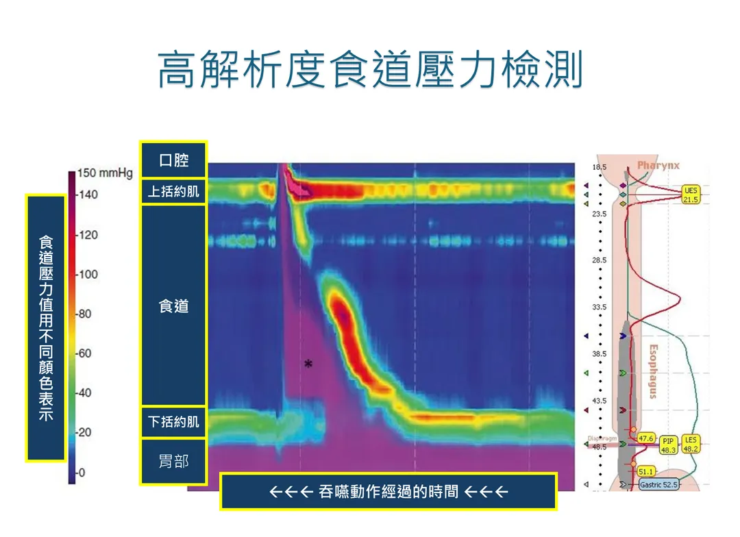 食道壓力檢測可以檢查從食道到胃間每一條肌肉是否協調，若出現肌肉力量不足或收縮過強則會影響消化。（圖／台東馬偕醫院）