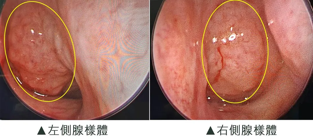 小兒呼吸中止症腺樣體肥大情形。(圖/澄清醫院)