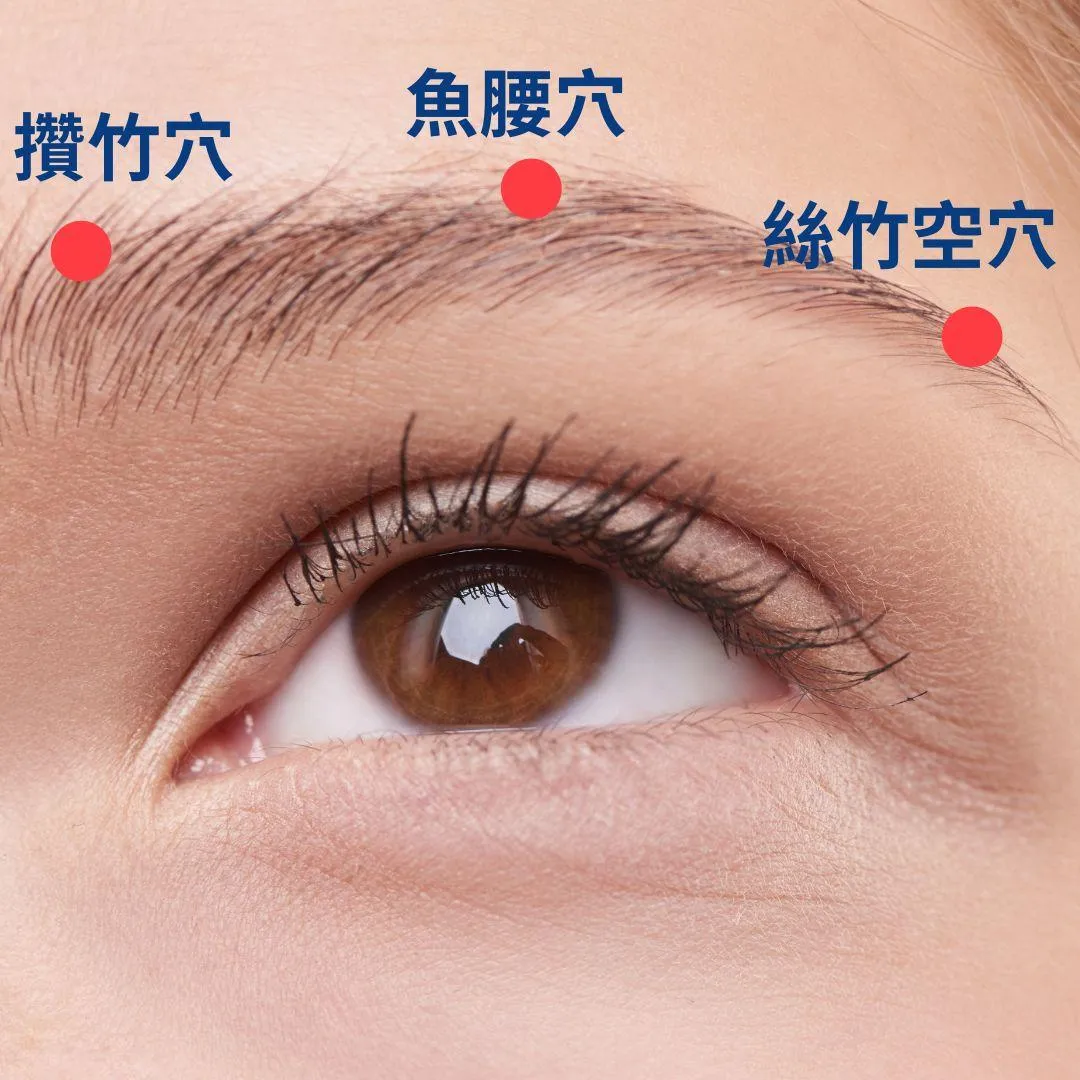 針灸眼周攢竹、魚腰、絲竹空等穴，協助舒緩眼部不適。（圖／台南市立醫院）