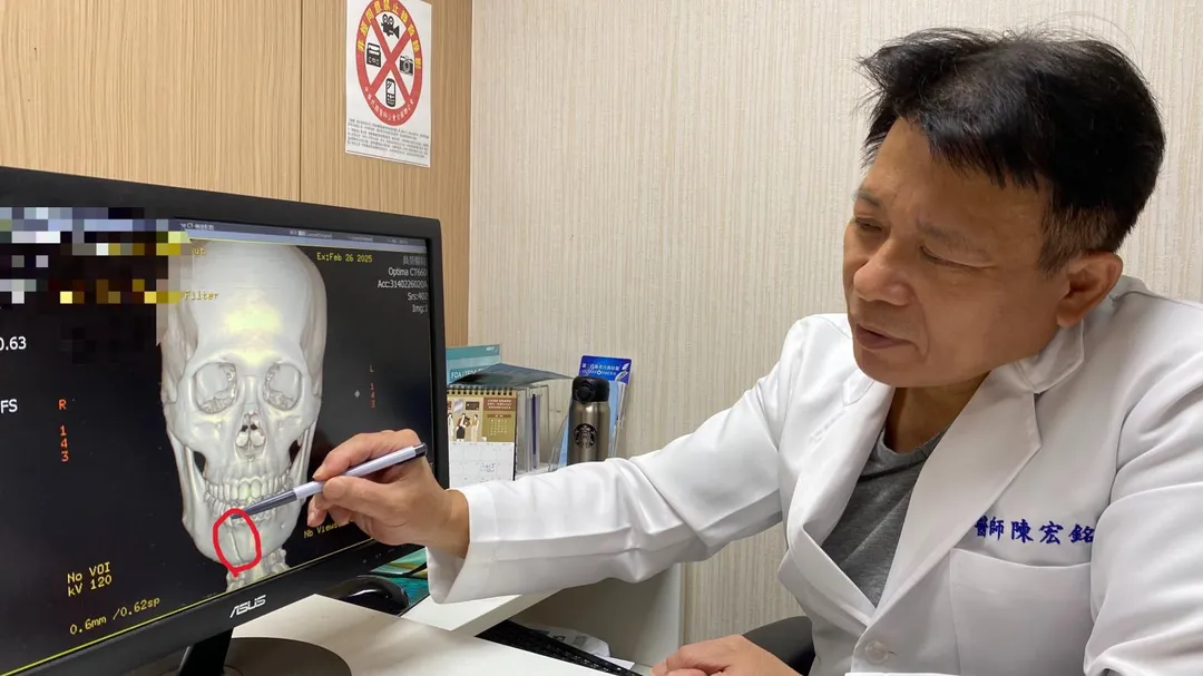 一名外勞被鋼筋擊中下巴，造成下頷骨骨折，如未即時手術，除會影響進食與咀嚼，若神經受壓迫，會導致下唇感覺無法恢復。（圖／員榮醫院）