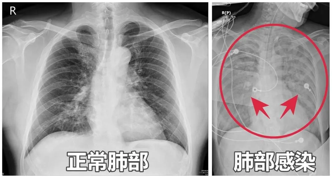 正常肺部與感染肺部對照圖。（圖／亞洲大學附屬醫院）