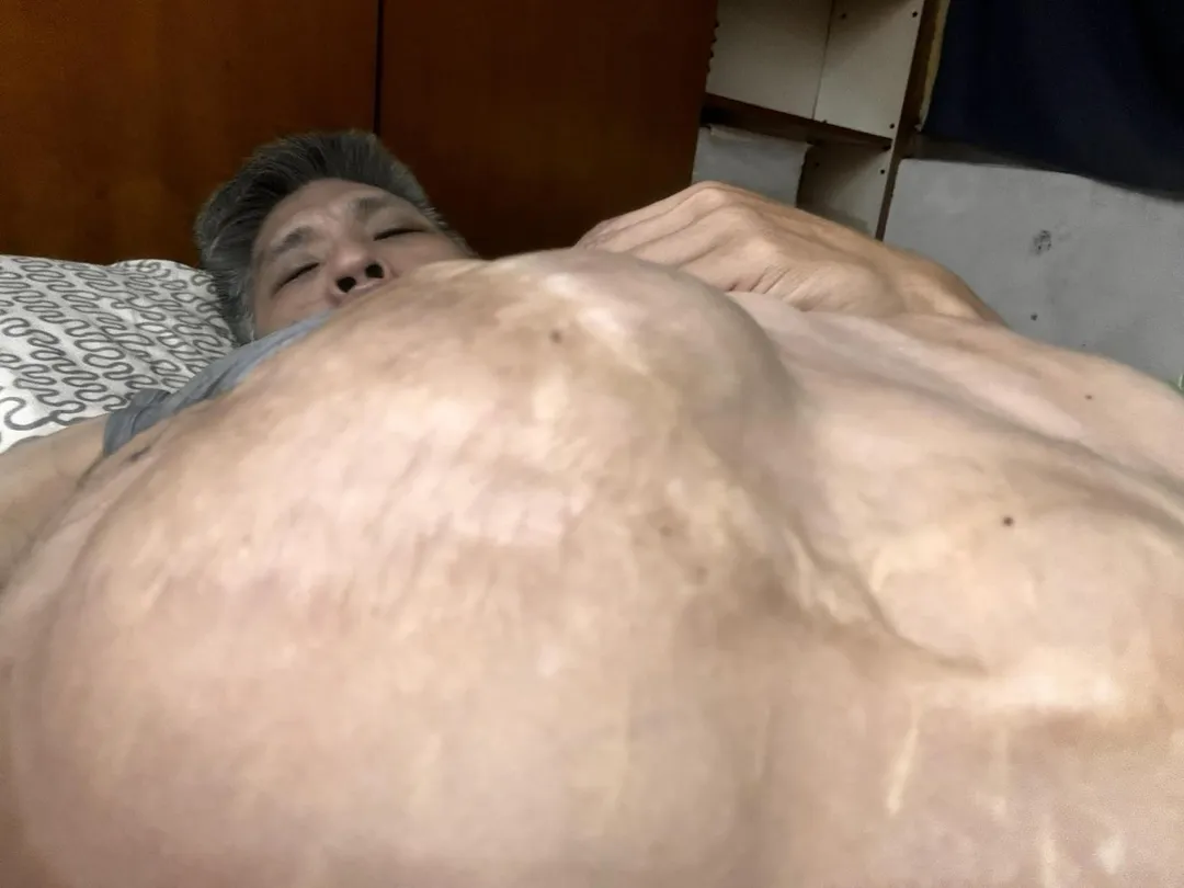 台灣首對接受分割手術成功存活的連體嬰兄弟檔,弟弟忠義傳出健康狀況惡化,腹部脹大程度令人不捨。(圖/翻攝自張中義臉書)