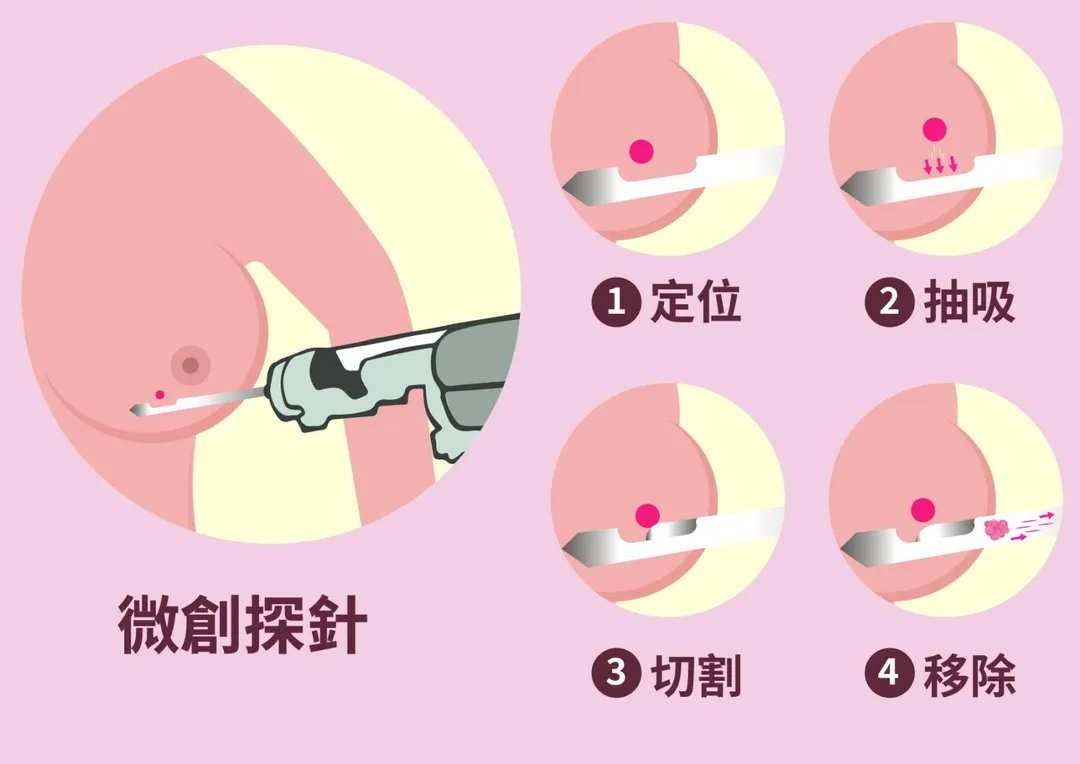 「真空輔助切除系統」的微創手術，僅需0.3至0.5公分的微小傷口，即可完整切除乳房腫瘤。（圖／國泰綜合醫院）