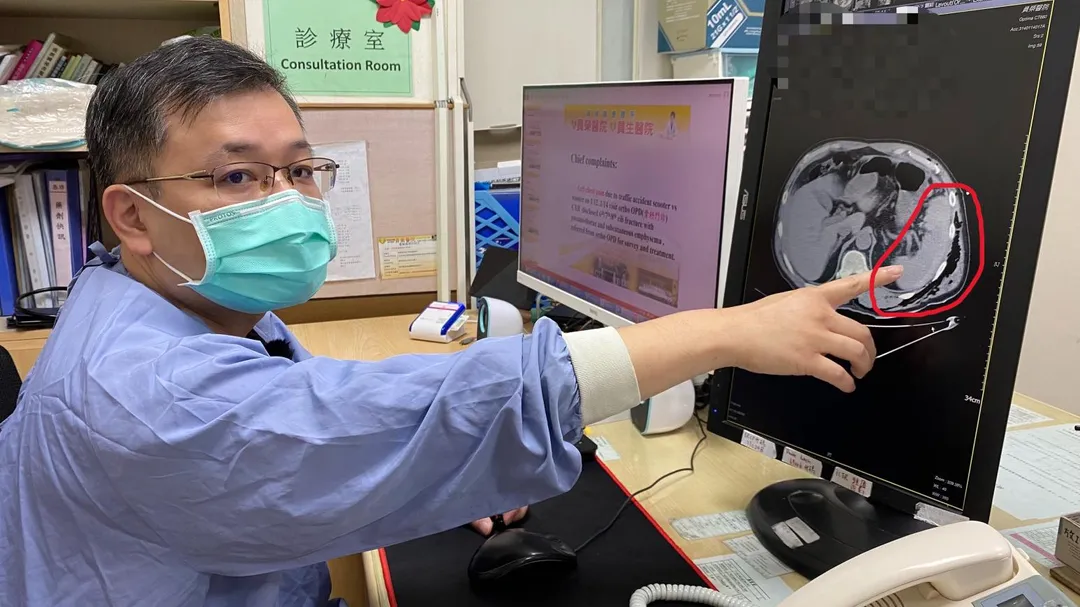 員榮醫療體系員榮醫院急診室翁聖富醫師解釋,張姓患者脾臟(圖中紅圈)破裂的情況。(圖/員榮醫院)