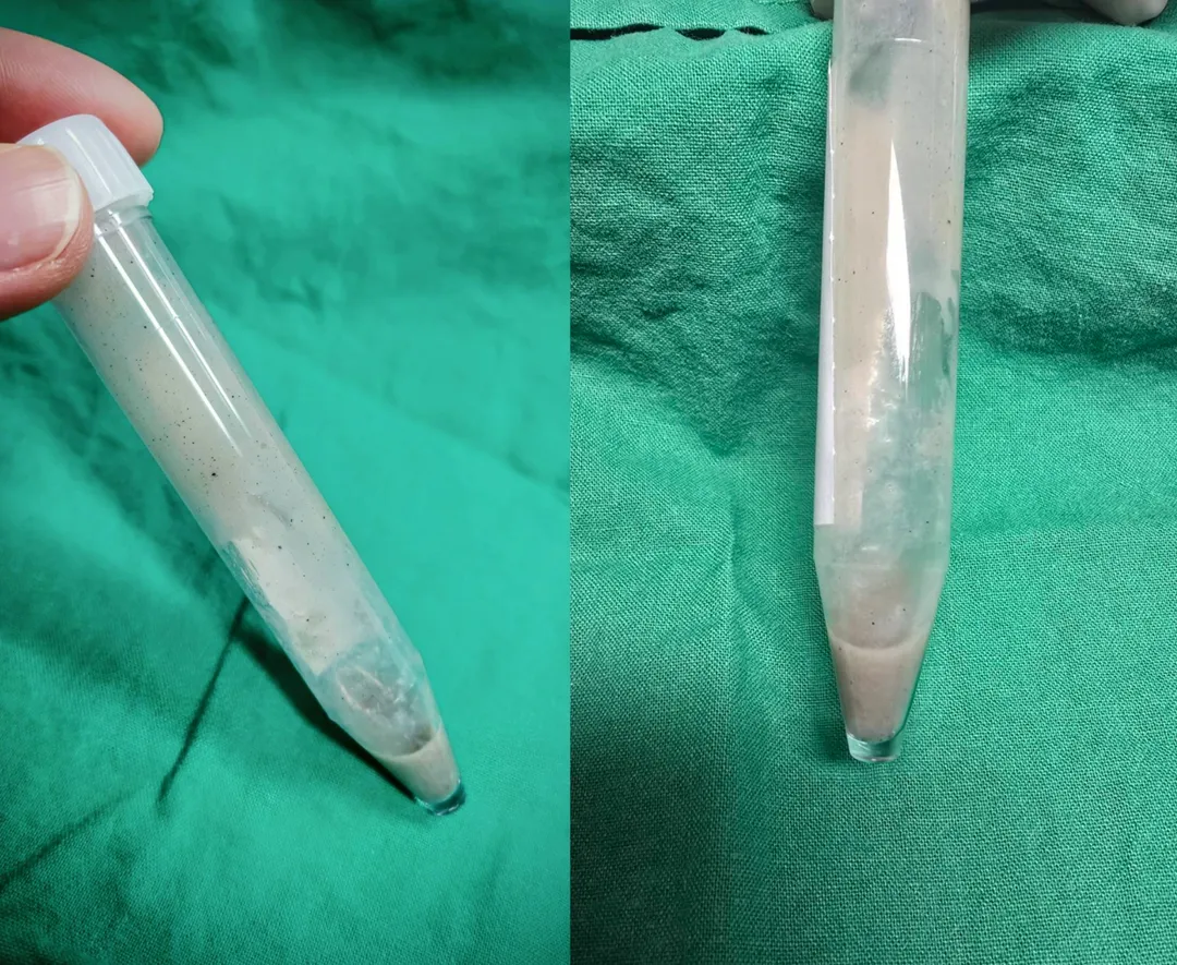 第一次支氣管鏡檢查，清理出不少混有泥沙細石的濃痰。（圖／花蓮慈濟醫院）
