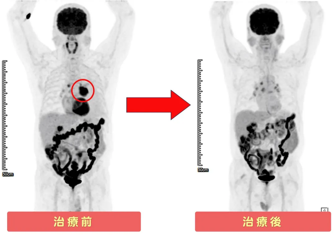 正子攝影治療前後對比。(圖/烏日林新醫院)