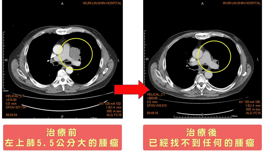 電腦斷層治療前後對比。(圖/烏日林新醫院)