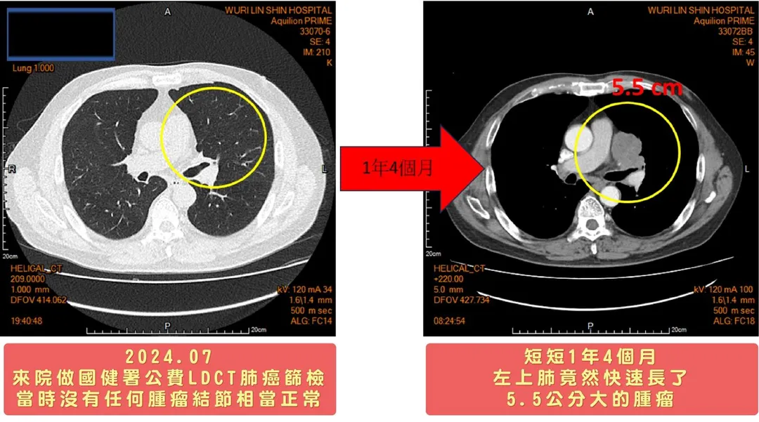 黃先生接受肺癌篩檢時肺部影像檢查沒有任何腫瘤結節相當正常,沒想到卻在短短1年4個月後左上肺竟然快速長了5.5公分大的腫瘤。(圖/烏日林新醫院)
