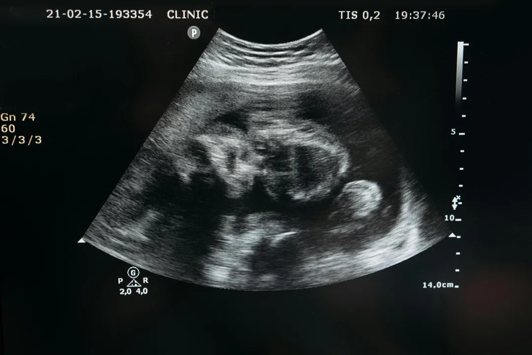 國健署已將《生育保健法》修正草案送入行政院審議，修法後已婚女性施行人工流產將不須取得配偶同意。（示意圖／Pexels）