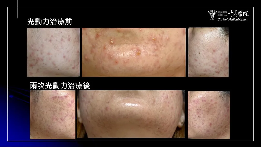 林小姐在兩個月內臉頰和下巴冒出很多紅色丘疹及膿皰，經過兩次光動力療法並加上外用藥物治療後，病灶有所改善。（圖／奇美醫院）
