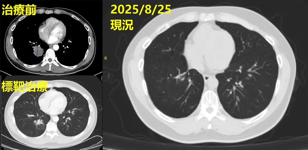 經治療後影像追蹤可見，原近4公分腫瘤明顯消失，病情獲得良好控制。（圖／彰化基督教醫院）