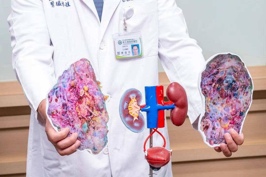陳老師因多囊腎導致腎臟異常腫大,切除後雙側病腎合計重達6公斤為正常人的20倍。(圖/彰化基督教醫院)