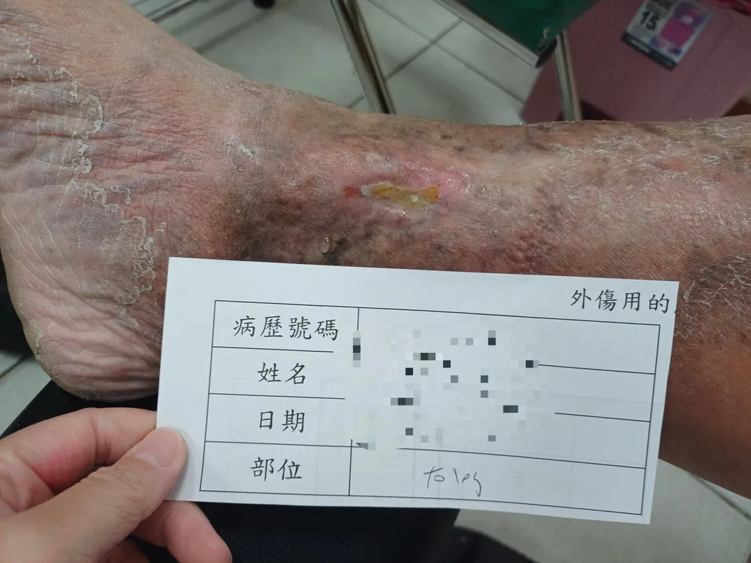 賴姓患者手術後一個多月後傷口全癒。(圖/員榮醫院)