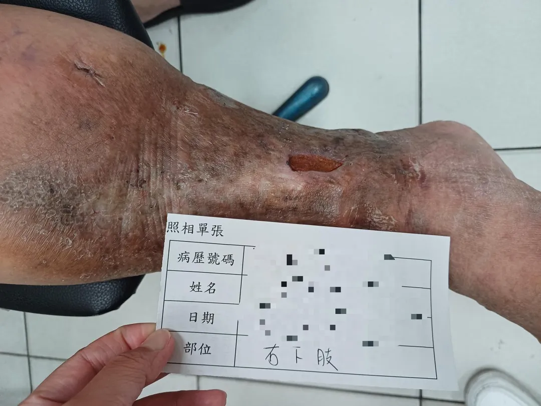 賴姓患者因右下肢靜脈瓣膜嚴重閉鎖不全,導致下肢血液回流受阻,小腿紅腫,傷口也十多年未癒合。(圖/員榮醫院)