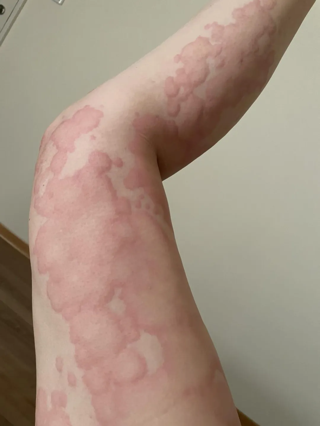 慢性蕁麻疹並非單純過敏反應，而是與自體免疫失調有關，症狀包括「紅、腫、癢」，嚴重時甚至可能危及生命。（圖／朱家瑜醫師提供）