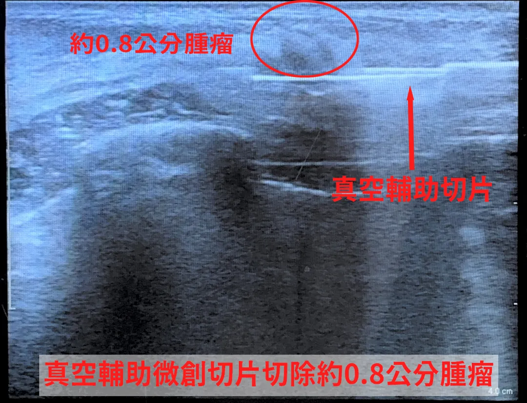 一名24歲年輕女性因乳房疼痛就醫，經檢查發現約0.8公分不規則邊緣腫瘤，且伴隨微鈣化。（圖／中國醫藥大學新竹附設醫院）