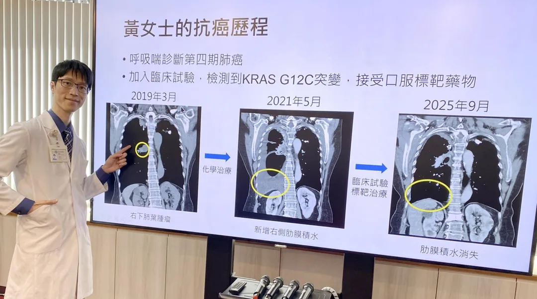 臺中榮總胸腔部醫師李柏昕說明，黃女士罹患第四期肺腺癌，經基因檢測發現帶有罕見癌基因KRAS G12C突變，使用標靶藥物有效控制病況。（圖／臺中榮總）